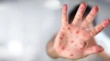 الصحة العالمية تصدر إرشادات جديدة للوقاية من جدرى القرود