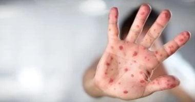 الصحة العالمية تصدر إرشادات جديدة للوقاية من جدرى القرود