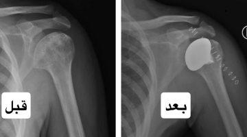 سعود الطبية تُجري أول عملية لتبديل رأس عظمة العضد في مفصل الكتف