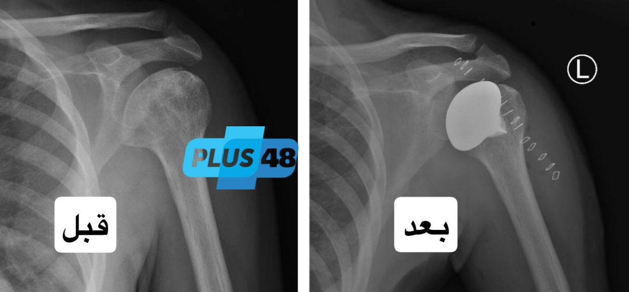 سعود الطبية تُجري أول عملية لتبديل رأس عظمة العضد في مفصل الكتف